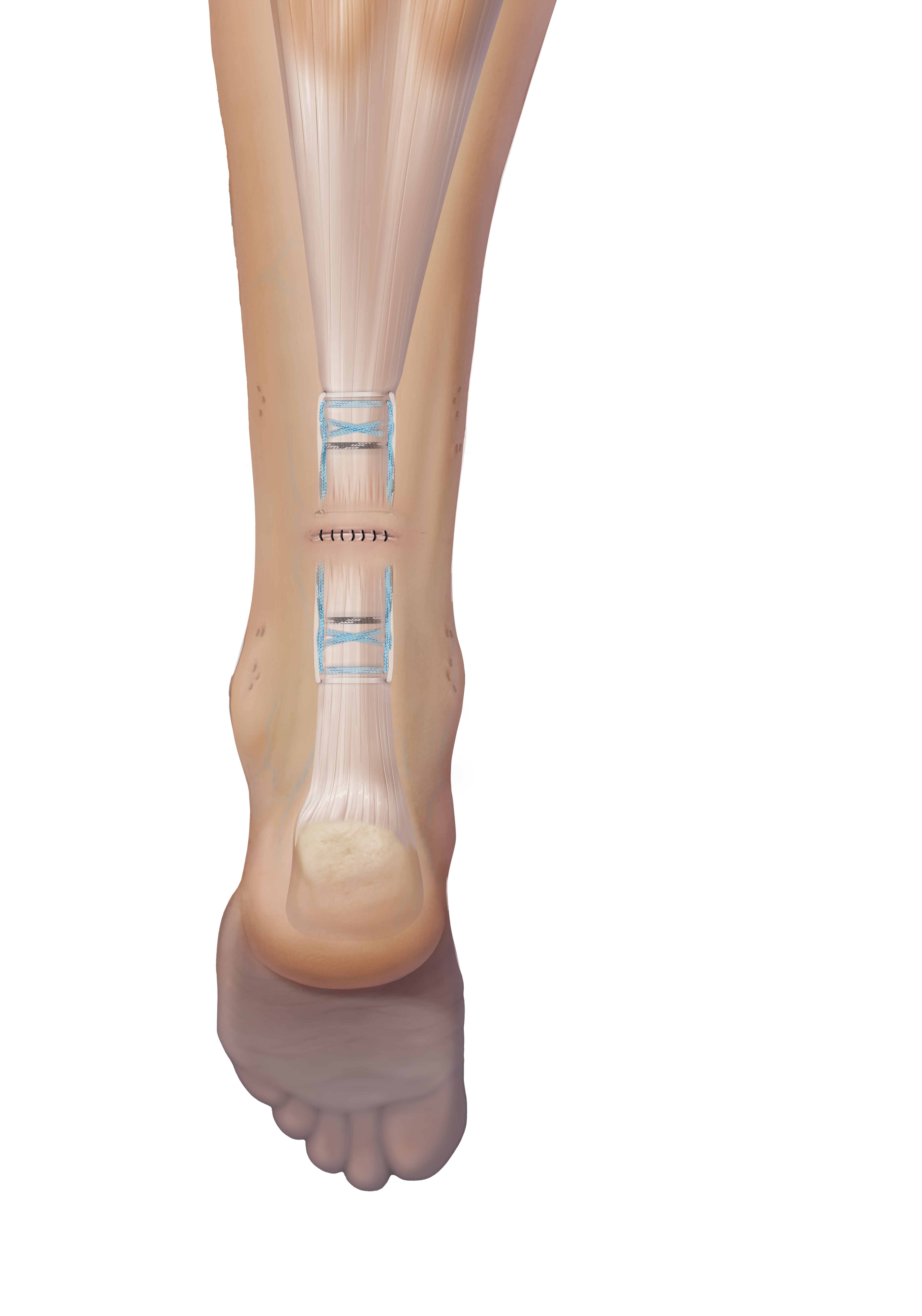 Arthrex - PARS (Percutaneous Achilles Repair System)